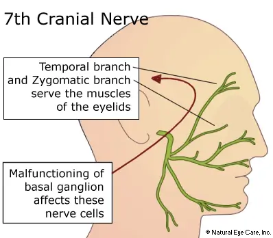 blepharospasm-1