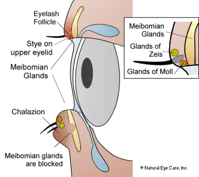 chalazion-sty