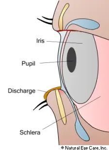 conjunctivitis-NEC