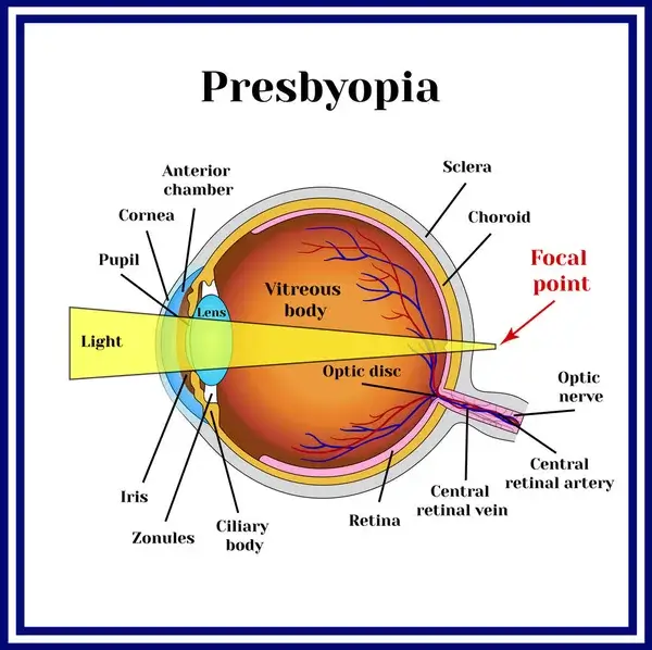depositphotos_130059718-stock-illustration-refractive-errors-eyeball-presbyopia