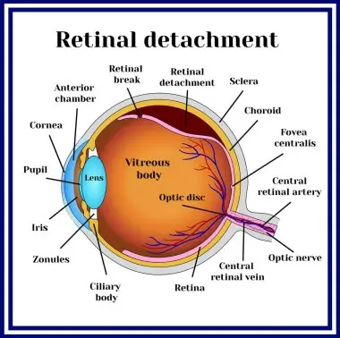 depositphotos_137215848-stock-illustration-retinal-detachment-disease
