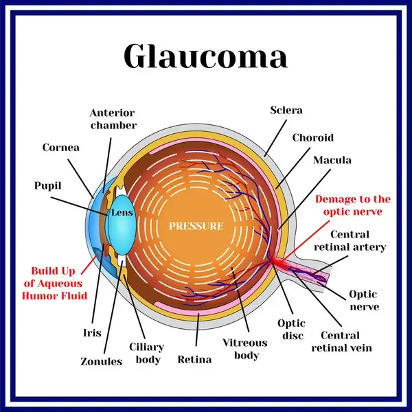 depositphotos_144434385-stock-illustration-normal-vision-glaucoma (2)