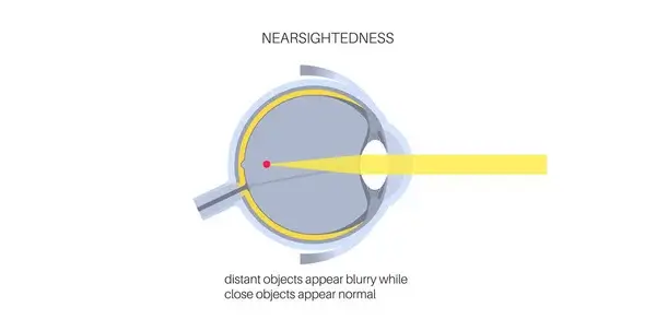 depositphotos_695330088-stock-illustration-nearsightedness-eye-disease-poster-myopia