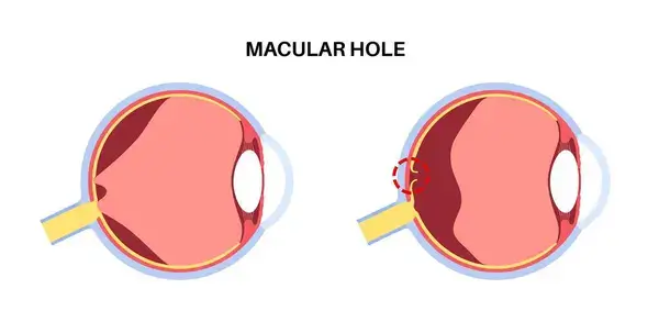 depositphotos_746202652-stock-illustration-macula-hole-eye-disease-anatomical