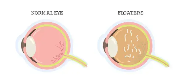 depositphotos_760988070-stock-illustration-cross-section-eye-floaters-vector