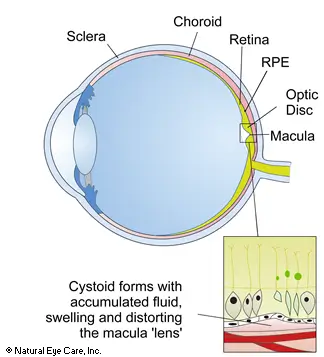 macular-edema