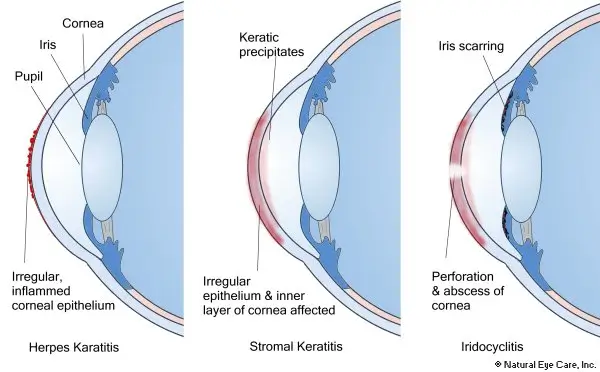 ocular-herpes