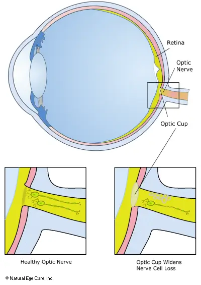 optic-nerve-atrophy