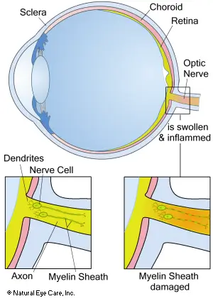 optic-neuritis