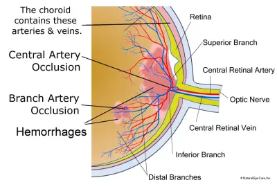 retinal-artery-occlusion
