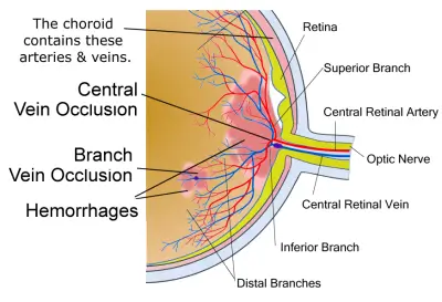 retinal-occlusion