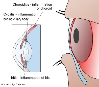 uveitis