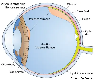 vitreous-detachment